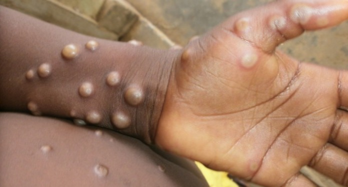 WHO Tetapkan Monkeypox Darurat Kesehatan Global