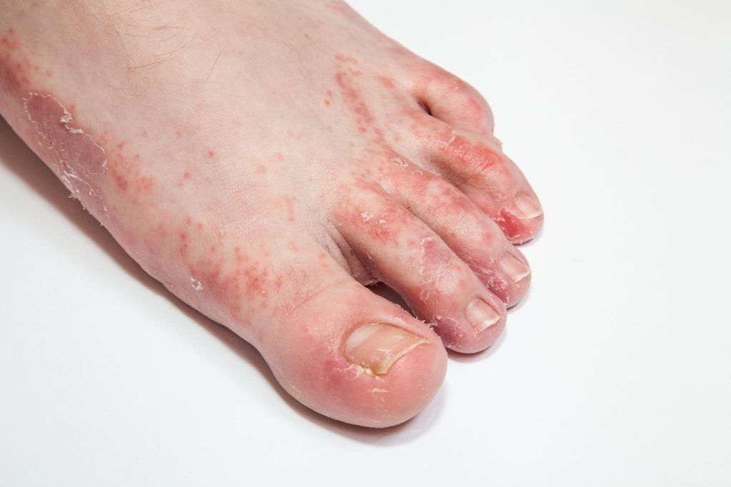 Jamur di kaki menyebabkan gatal dan panas